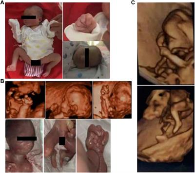 Prenatal diagnosis in a fetuses with a clenched hands, overlapping fingers, and clubfoot due to MED12 deficiency in three affected siblings: A case report